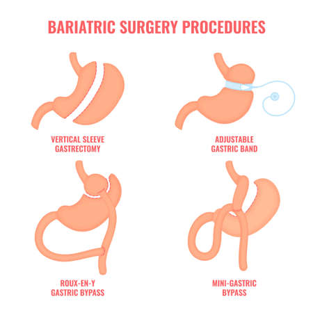 Types of bariatric surgery weight loss procedures- gastric bypass, sleeve gastrectomy, adjustable gastric band. Stomach reduction medical diagram infographic. Health care concept. Vector illustration.のイラスト素材