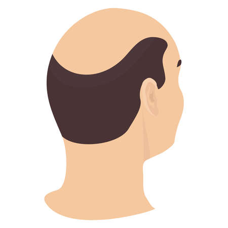 Head of a man with hair loss in side view. Different stages of alopecia in men. Health care and beauty concept. Vector cartoon illustrationのイラスト素材