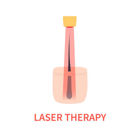 Laser hair growth stimulation. Red light therapy for hair restoration in androgenetic alopecia. Medical concept. Vector illustration.のイラスト素材