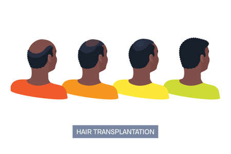 Afro-textured hair transplantation surgery result infographics. African male patient before and after hair loss treatment with FUT, FUE methods. Treating alopecia medical poster. Vector illustration.のイラスト素材