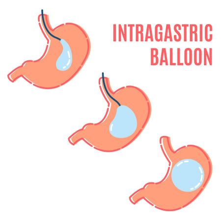 Gastric balloon non surgical weight loss procedure in stomach. Intragasric balloon placement infographic poster. Health care and medical concept. Vector illustration in flat style.のイラスト素材