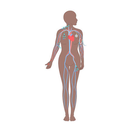 Central venous catheter placement sites shown on the female body. Types of central lines. Woman with...