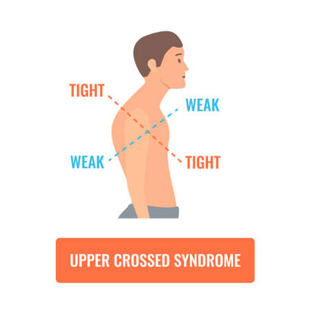 Upper crossed syndrome medical diagram. Crooked man with muscle strength imbalance. Weak and overactive muscles therapy. Incorrect spine curvature caused by bad posture. Vector illustration.のイラスト素材