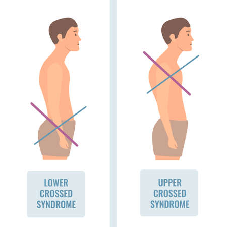 Upper and lower crossed syndrome medical diagram. Crooked man with muscle strength imbalance. Weak and overactive muscles therapy. Incorrect spine curvature caused by bad posture. Vector illustration.のイラスト素材