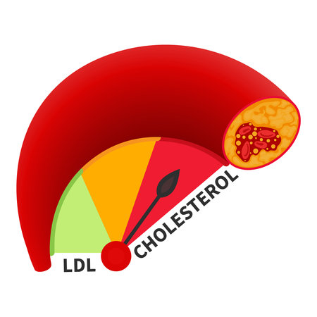 LDL cholesterol level on blocked blood vessel medical diagram. Meter gauge of low density lipoprotein. High fat test indicator. Atherosclerosis risk. Healthcare concept. Vector illustration.のイラスト素材