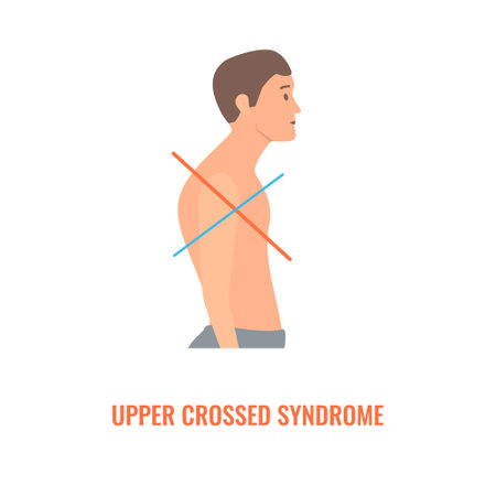 Upper crossed syndrome medical diagram. Crooked man with muscle strength imbalance. Weak and overactive muscles therapy. Incorrect spine curvature caused by bad posture. Vector illustration.のイラスト素材