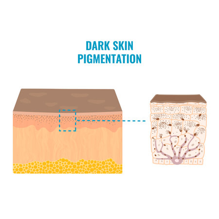 Melanin content and distribution in dark skin phototype. Pigmentation mechanism infographic diagram. Epidermis cross-section in closeup. Vector illustration.のイラスト素材
