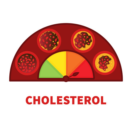 Cholesterol level on blocked blood vessel medical diagram. Atherosclerosis risk scale. Meter gauge of ldl and hdl lipoprotein. High and low fat test indicator. Healthcare concept. Vector illustration.のイラスト素材