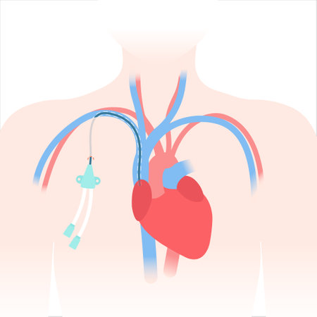 Tunneled central venous catheter placed in the subclavian vein. Patient with CVC long term access device for chemotherapy infusions and blood sampling. Central line tube close up. Vector illustration.のイラスト素材