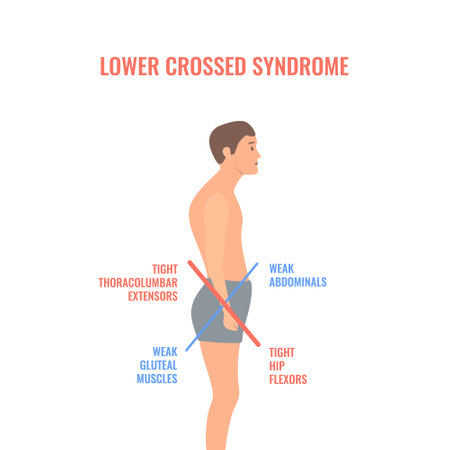 Lower crossed syndrome medical diagram. Crooked man with muscle strength imbalance. Weak and overactive pelvis muscles therapy. Incorrect spine curvature caused by bad posture. Vector illustration.のイラスト素材