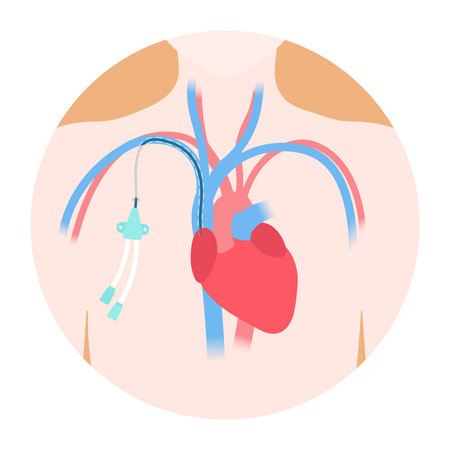 Tunneled central venous catheter placed in the subclavian vein. Patient with CVC long term access device for chemotherapy infusions and blood sampling. Central line tube close up. Vector illustration.のイラスト素材