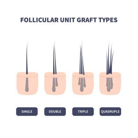 Hair micrograft classification set for hair transplantation surgery. Skin cross-section with number of hairs in the follicular unit or family. Hair science and anatomy. Cartoon vector illustration.のイラスト素材