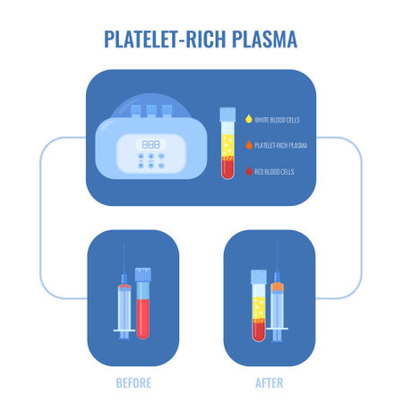 Blood after separation of platelets in the centrifuge. PRP test tube laboratory equipment. Platelet-rich plasma for patient treatment. Regenerative medicine concept. Vector illustration.のイラスト素材