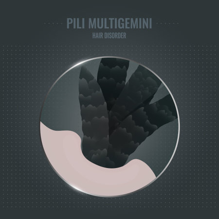 Pili multigemini hair disorder surface under microscope. Multiple hair shafts ingrowth condition closeup vector. Trichology medical concept.のイラスト素材
