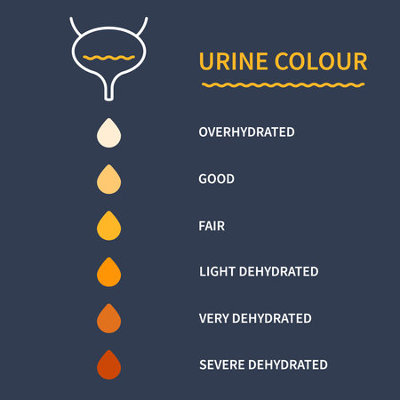 Urine color chart diagram. Bladder with urine drops showing different hydration level. Straw yellow to brown pee specimen. Medical concept. Vector illustration.のイラスト素材