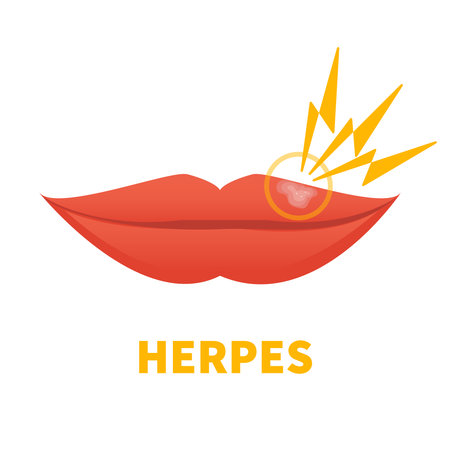 Herpes Simplex Virus on lips. Cold sore outbreak. Oral disease. Herpetic lesions treatment. Medical concept. Vector illustration isolated on white.のイラスト素材
