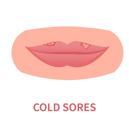 Cold sores outbreak. Herpes Simplex Virus on lips. Oral viral infection disease. Facial herpetic lesions treatment. Medical concept. Vector illustration isolated on white.のイラスト素材