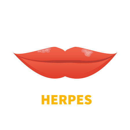 Herpes Simplex Virus on lips. Cold sore outbreak. Oral disease. Herpetic lesions treatment. Medical concept. Vector illustration isolated on white.のイラスト素材