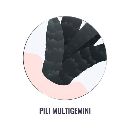Pili multigemini hair disorder surface under microscope. Multiple hair shafts ingrowth condition closeup vector. Trichology medical concept.のイラスト素材