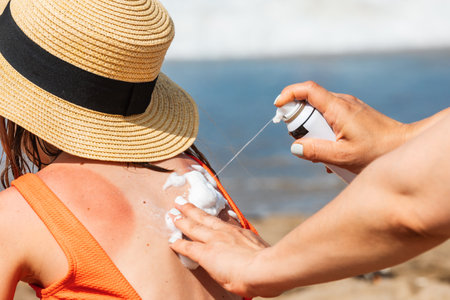 Mother spraying panthenol foam on her daughter's sunburnt back on a beachの写真素材