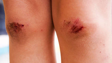 Kid Injured after running and playing with her friendsの写真素材