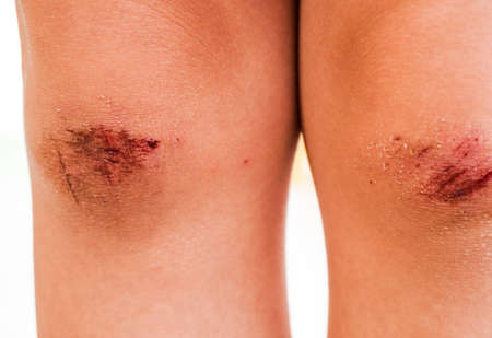 Kid Injured after running and playing with her friendsの写真素材