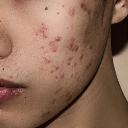 Close up of Acne on the skin, Acne on the face caused by Hormone, Acne inflammation and Wrinkle on the face skinの写真素材