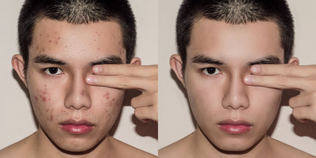 Young man with before and after treatment from acne and pimple, Before and after of face skin treat by scars and wrinkle by acne removal. Spots skin by acne and Smooth skin by treatment.の写真素材