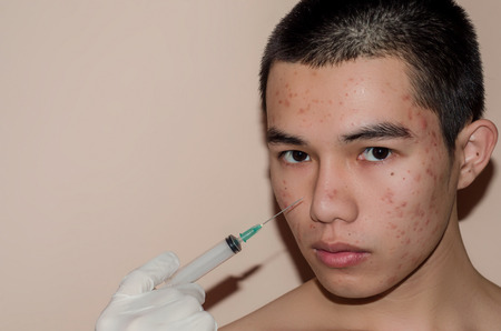 Young man with acne and pimple on the skin with brown spots, Acne on the face caused by Hormone or grime and bacteria, The scars and wrinkle and acne inflammation on the face skin.の写真素材