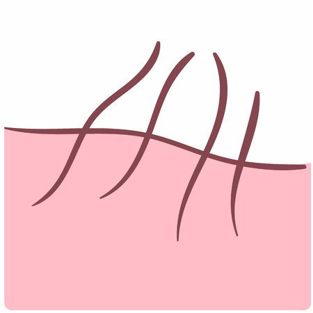 Illustration of skin with growing hair. Can be used as symbol of dermatologyのイラスト素材