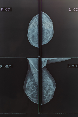 Mammography breast scan X-ray imageの写真素材