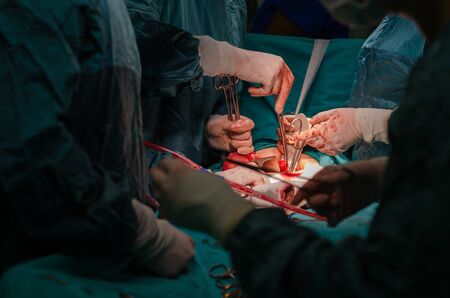 Hysterectomy surgery,  Male surgeon doctor and nurses at operationの写真素材