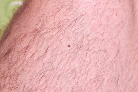 Mole on the male hairy leg.の写真素材