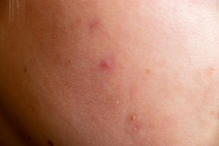 Skin with close-up macro pimples. Skin problems, dermatologyの写真素材