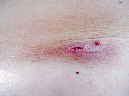Pimple Extreme Macro on an adult man skin