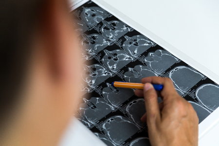 CT scans on desk and doctor hands pointing at x-ray with pen. Over the shoulder.の写真素材