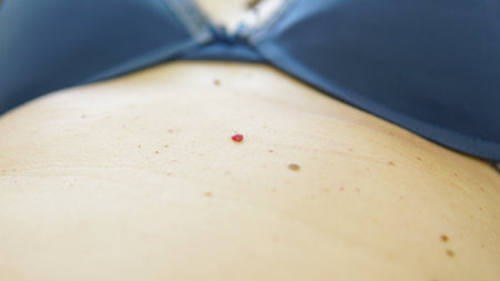 Red moles and dots on the female body. Large mole on stomach. Melanoma, hemangiomas, lipoma, atheroma, malignant and benign moles. oncology. The medicine. Close-up photo, blurry. nの写真素材