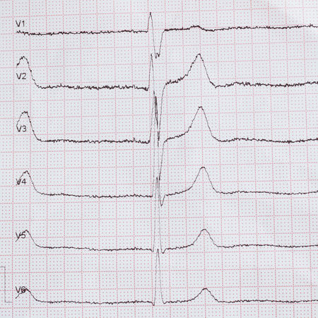 Cardiogram on paper. Shows heart rate monitor