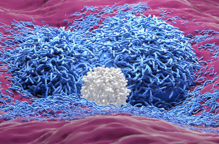 Liver cancer hepatoma blue color with t-cell realistic closeup view 3d illustration