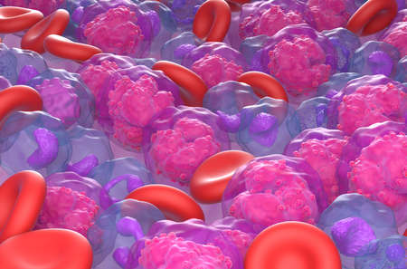 Acute lymphoblastic leukemia (ALL) cancer cells in the blood flow - field closeup view 3d...