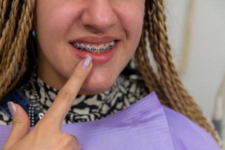 Happy teen girl showing toothy smile, pointing finger at teeth and braces. Clinic patient satisfied with dentist service, dental care, correction. Close upの写真素材