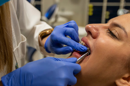 Installation process temporary tooth in self-ligating braces for a perfect smile. Orthodontic treatment of teeth. Dental care.の写真素材