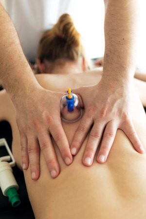 Shot of physiotherapist applying cupping treatment to the patient in a physiotherapy room.の写真素材