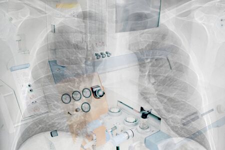 Double exposure of x-ray image of lung with pneumonia and ICU medical ventilatorの写真素材