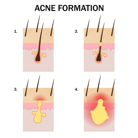 Stages of acne formation on the human skinのイラスト素材