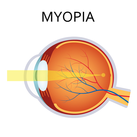 Myopia is being short sighted. Far away object seems blurry. Detailed anatomy of the eye.のイラスト素材