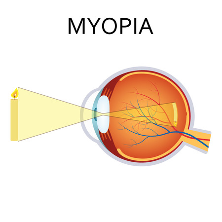 Myopia is being short sighted. Far away object seems blurry. Detailed anatomy of the eye.のイラスト素材