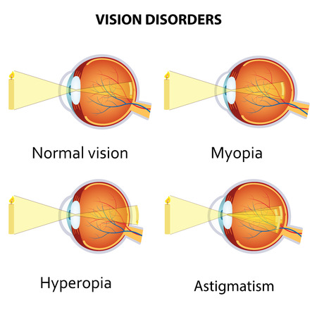 Common vision disorders. Astigmatism, Myopia and Hyperopiaのイラスト素材