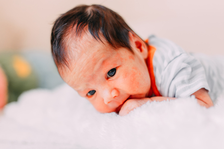 newborn baby boy or girl skin allergy lying on bedの写真素材