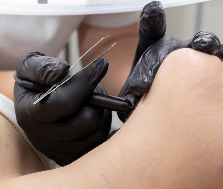 Dermatologist doing hair removal treatment on womans neck with electrolysis. Electric Epilation In Beauty Salon, Unrecognized Patient. Horizontal Plane. Authentic Photoの写真素材